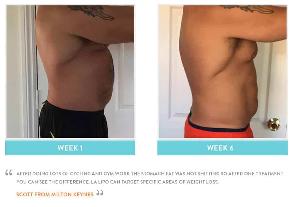 Before & After Stomach Fat Shoreham-by-Sea