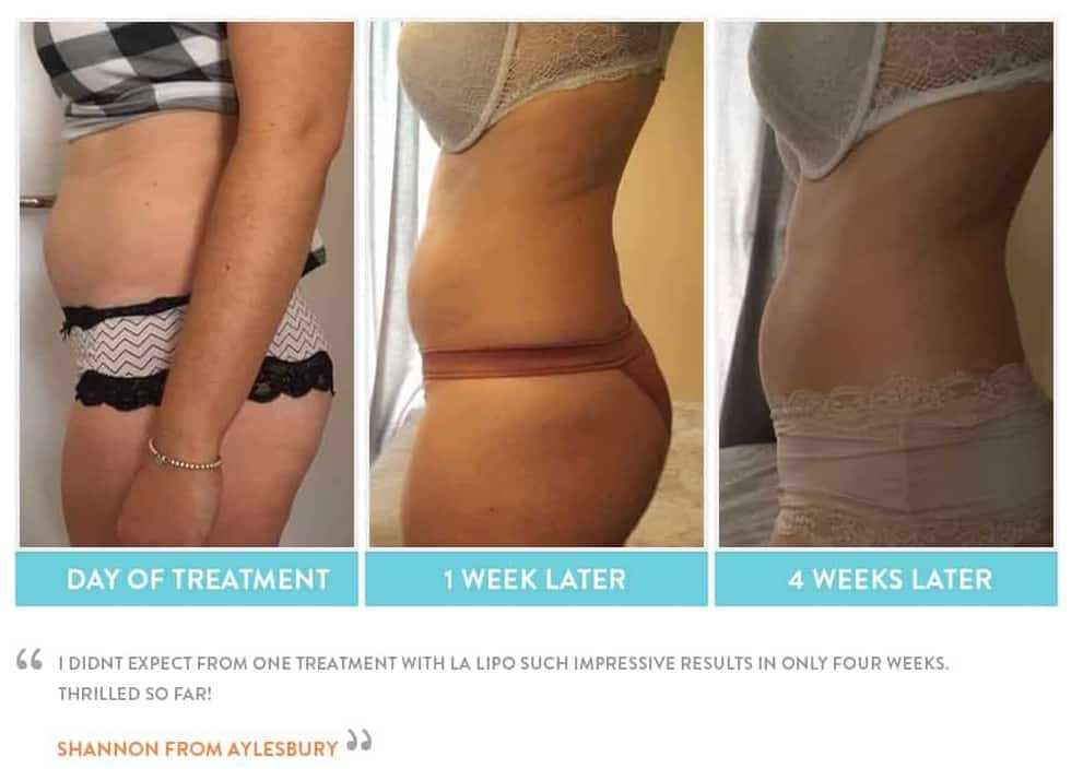 before, Cryolipolysis Shoreham-by-Sea