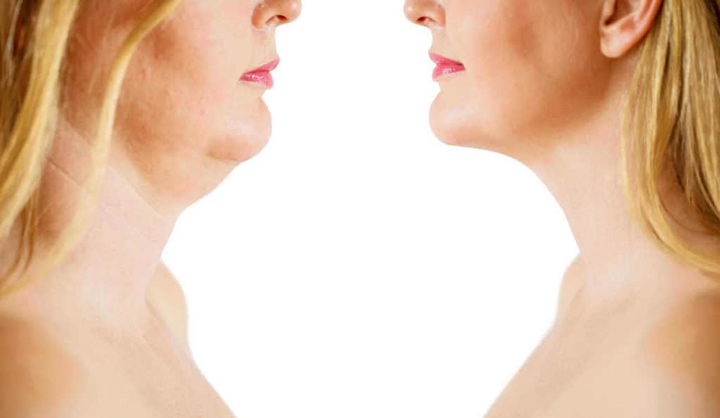 Double Chin treatment Shoreham-by-Sea before and after results