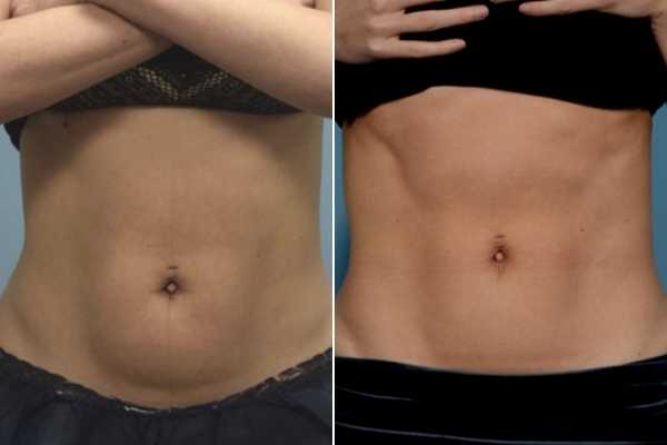 body sculpting FAQs Shoreham-by-Sea