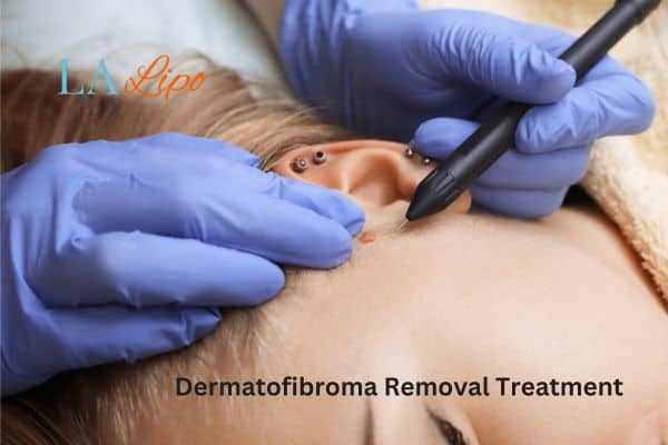 Dermatofibroma Removal Treatment Shoreham-by-Sea