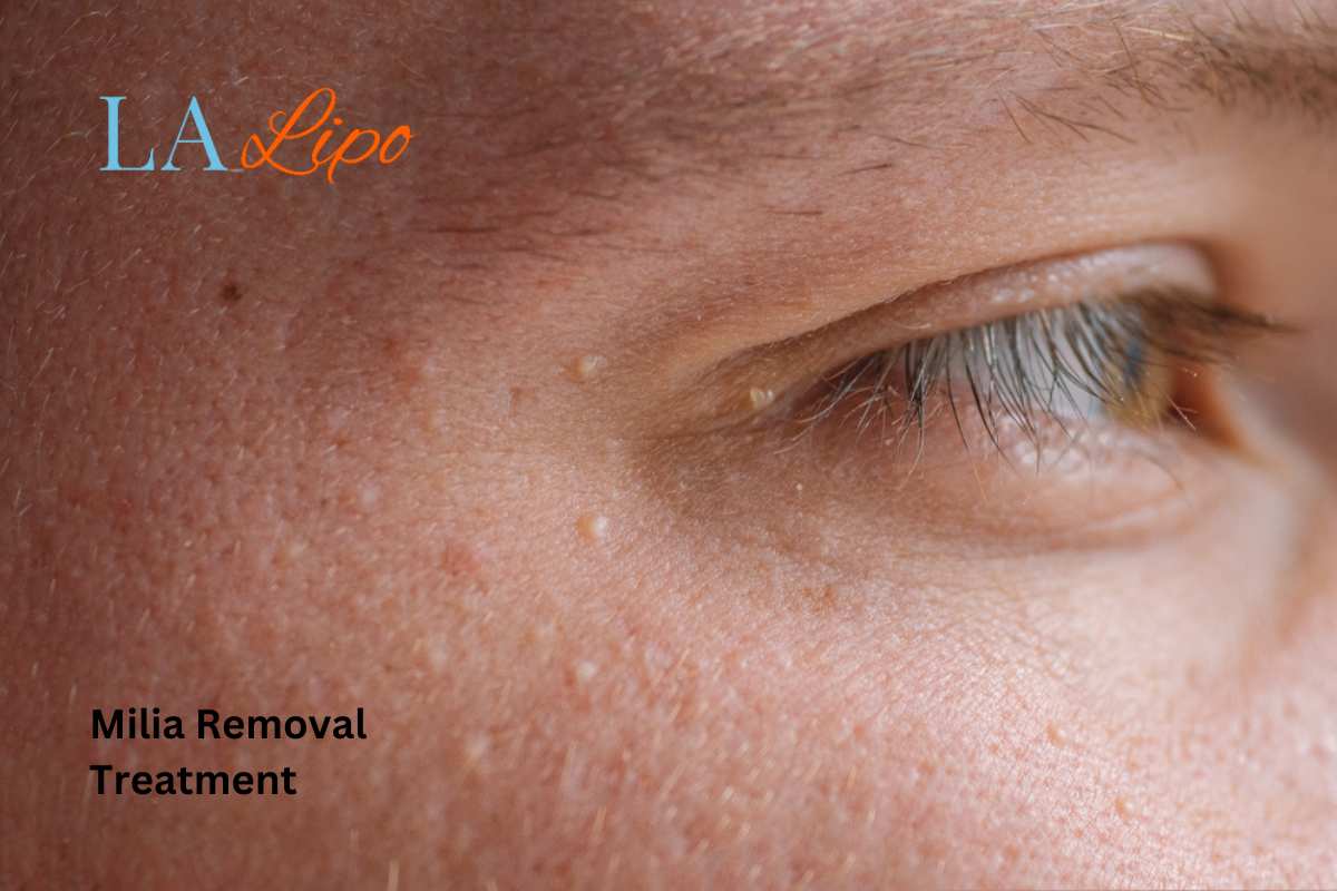 Cryopen Milia Removal: Is It the Easiest and Safest Option Shoreham-by-Sea?