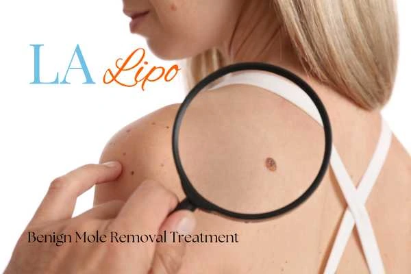 Woman having her inspection of blemish before mole removal Shoreham-by-Sea