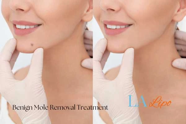 woman's before and after mole removal Shoreham-by-Sea results