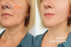 hi-fu for wrinkles Shoreham-by-Sea before and after results