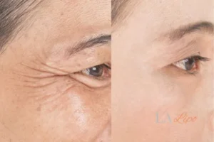 Before and after results of woman - HI-fu wrinkles reduction treatment Shoreham-by-Sea