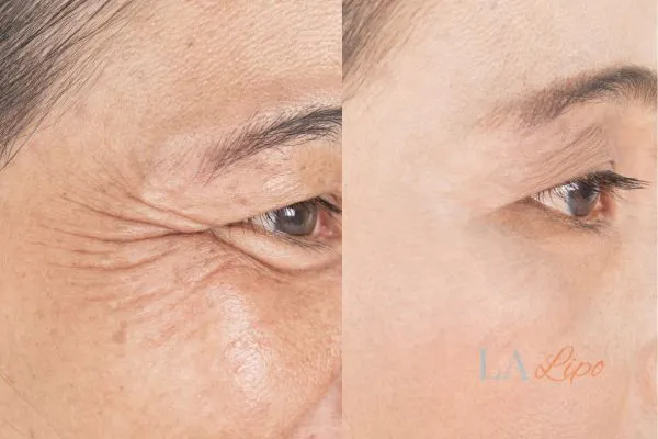Before and after results of woman - HI-fu wrinkles reduction treatment Shoreham-by-Sea