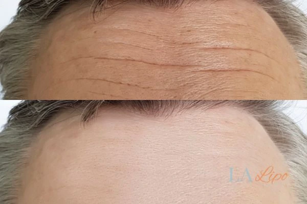 results of HIFU Shoreham-by-Sea on mans forehead to help reduce lines and wrinkles