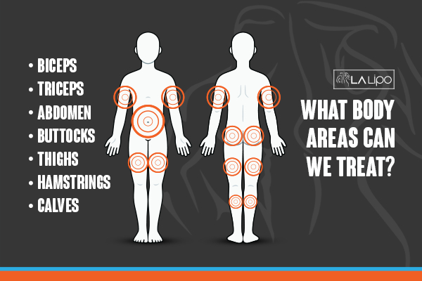 Graphic to show areas you can have LA-EMS Body Sculpting Shoreham-by-Sea treatment.