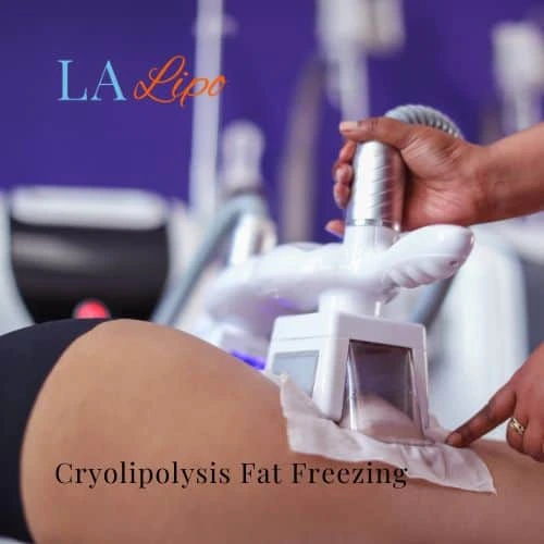 fat freezing - Cryolipolysis Shoreham-by-Sea