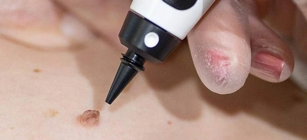 skin tag removal using cryopen Shoreham-by-Sea