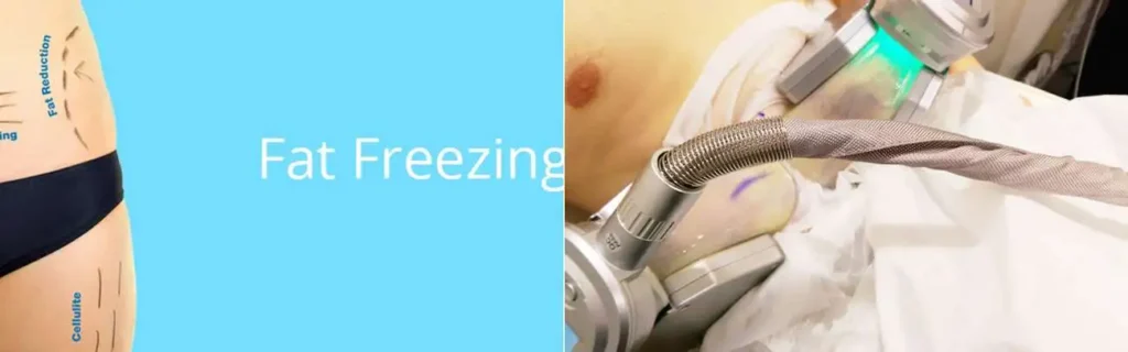 Fat freezing Shoreham-by-Sea on multiple areas of the body