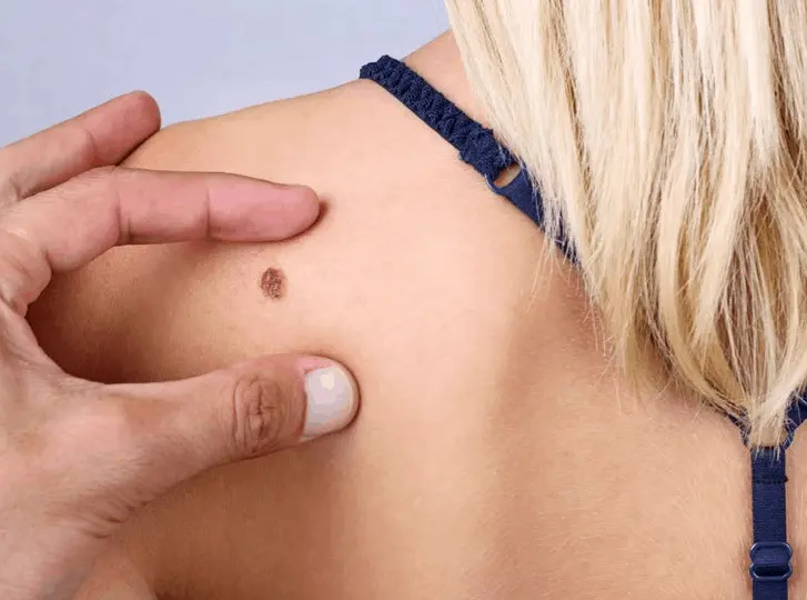 woman having mole removal Shoreham-by-Sea consultation before treatment.