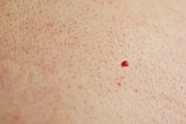 close up of a cherry angioma Shoreham-by-Sea