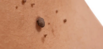 image of a skin tag Shoreham-by-Sea