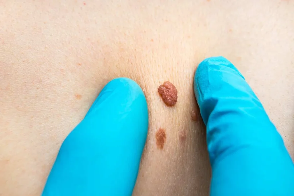 Consultant examining a skin tag Shoreham-by-Sea