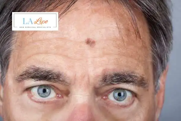 Solar Lentigo Removal Shoreham-by-Sea image of man with mark on his forehead