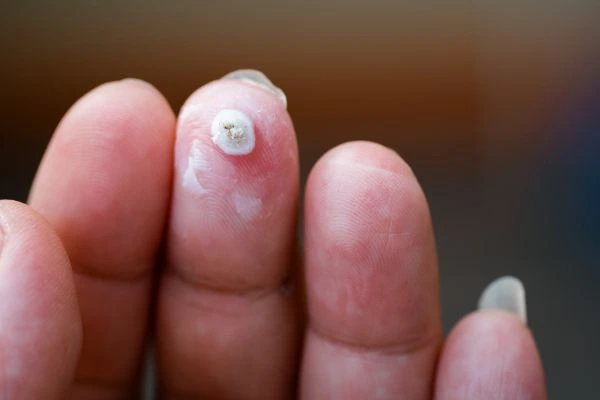 wart on person finger - cryotherapy to treat from LA LIPO Shoreham-by-Sea