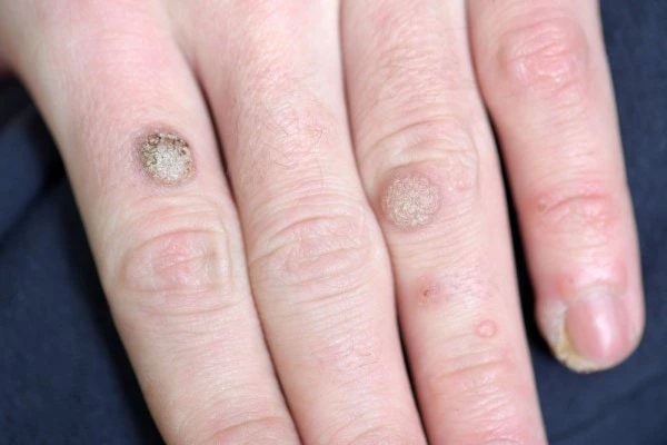 photo of warts on person hand - see wart removal Shoreham-by-Sea from LA LIPO