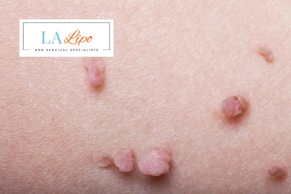 Does cryopen skin tag removal Shoreham-by-Sea hurt? Find out now call our team today!
