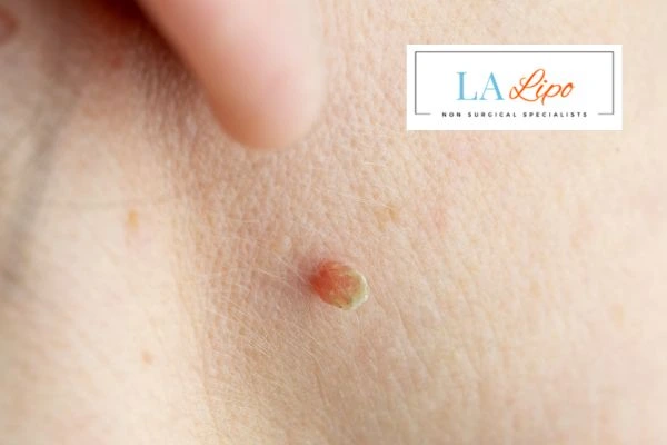Book skin tag removal Shoreham-by-Sea today speak to our team now!
