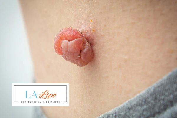 Interested in skin tag removal Shoreham-by-Sea? Concerned about the pain? Find out more today!