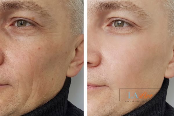 See the amazing results of Morpheus8 Treatment Shoreham-by-Sea!