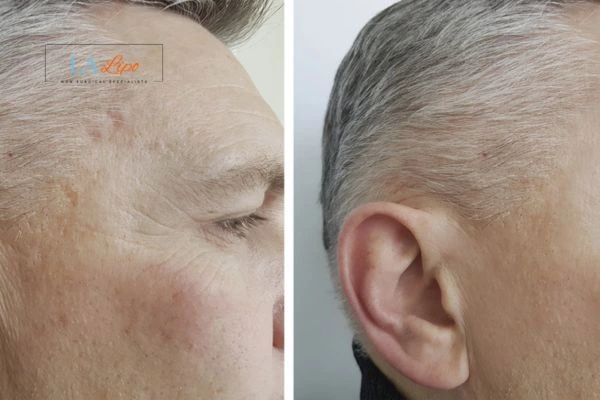 Mens Before & After Morpheus 8 Results Shoreham-by-Sea