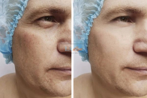 Before and after Morpheus 8 Results Shoreham-by-Sea