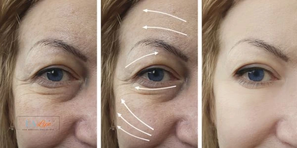 Amazing eye lift Morpheus 8 results Shoreham-by-Sea