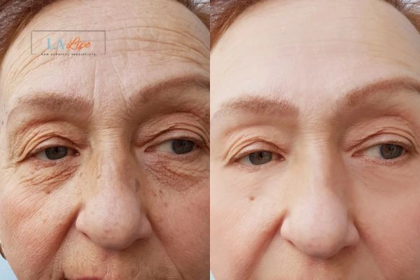 The powerful benefits of Morpheus8 Treatment Shoreham-by-Sea - Call Our team today!