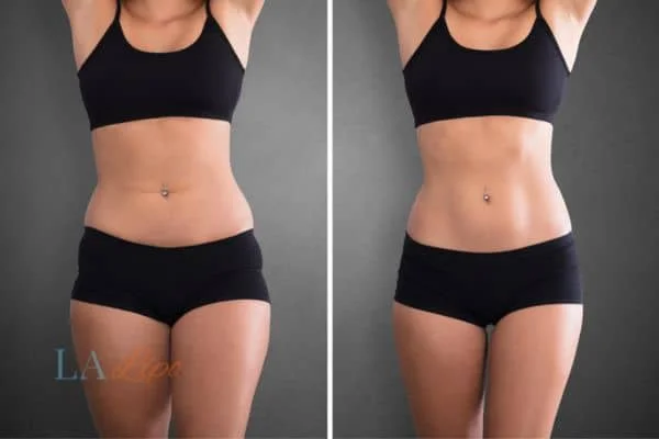 before and after results of non-surgical treatment to help a woman's body image and mental health Shoreham-by-Sea