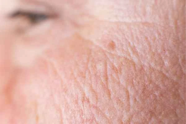 close up picture of a woman's face showing an age spot Shoreham-by-Sea