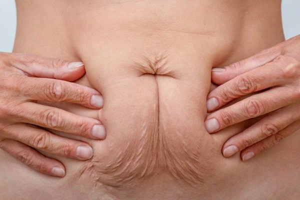 Image of a woman's stomach with loose skin - example of skin tightening Shoreham-by-Sea options