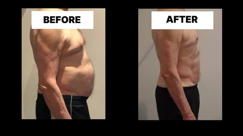 What Symptoms Can Diastasis Recti Cause in Men? Weak Core, Back Pain and Poor Posture Shoreham-by-Sea
